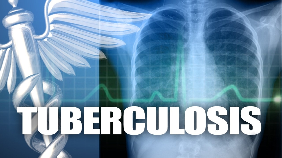 Alabama tuberculosis testing results