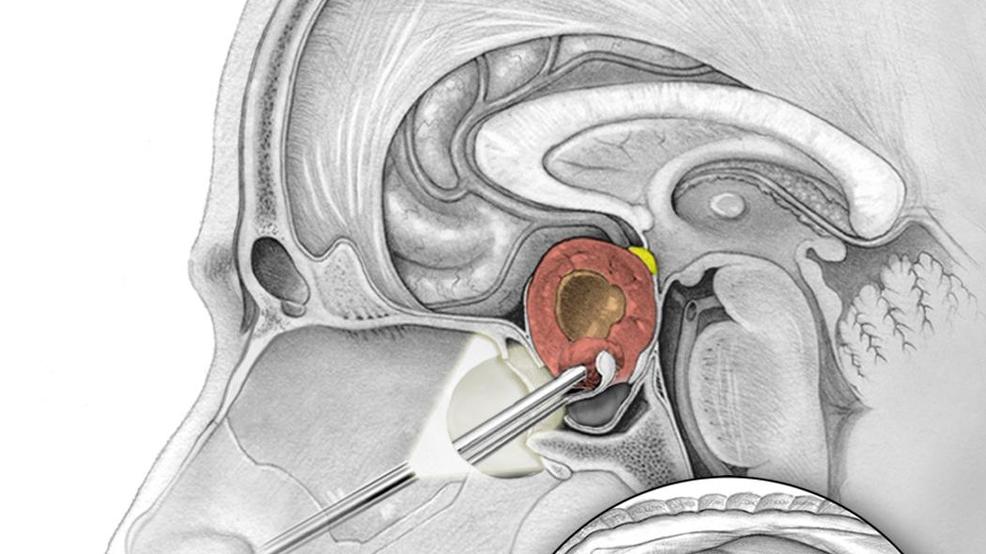 Why It s Safer Than Ever To Remove Pituitary Tumors WKRC